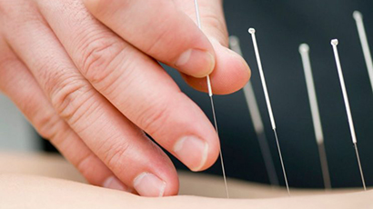 Acupuntura